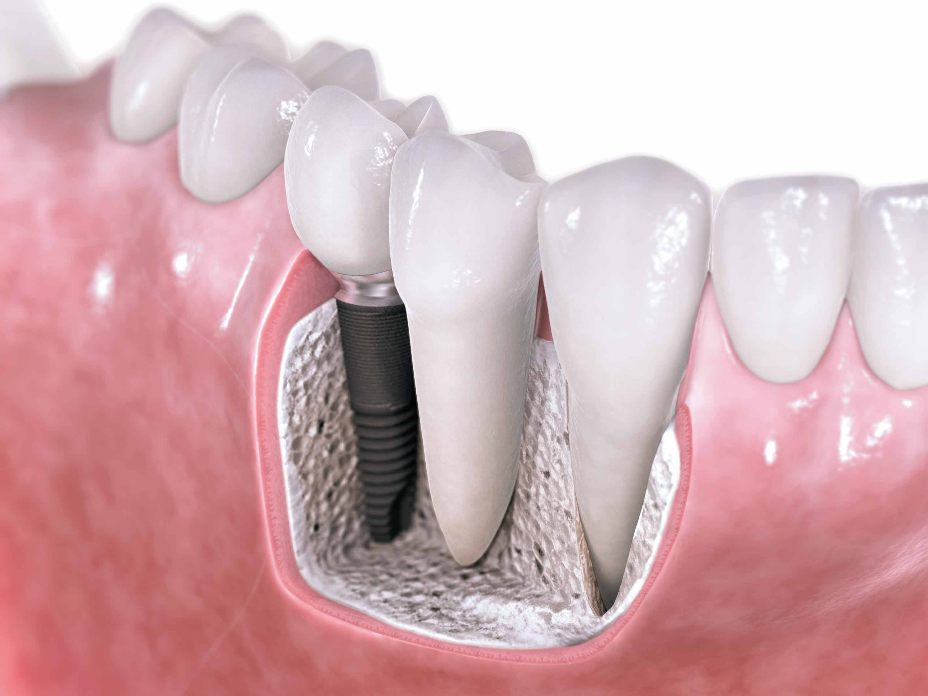 Newton MA Dental Implants