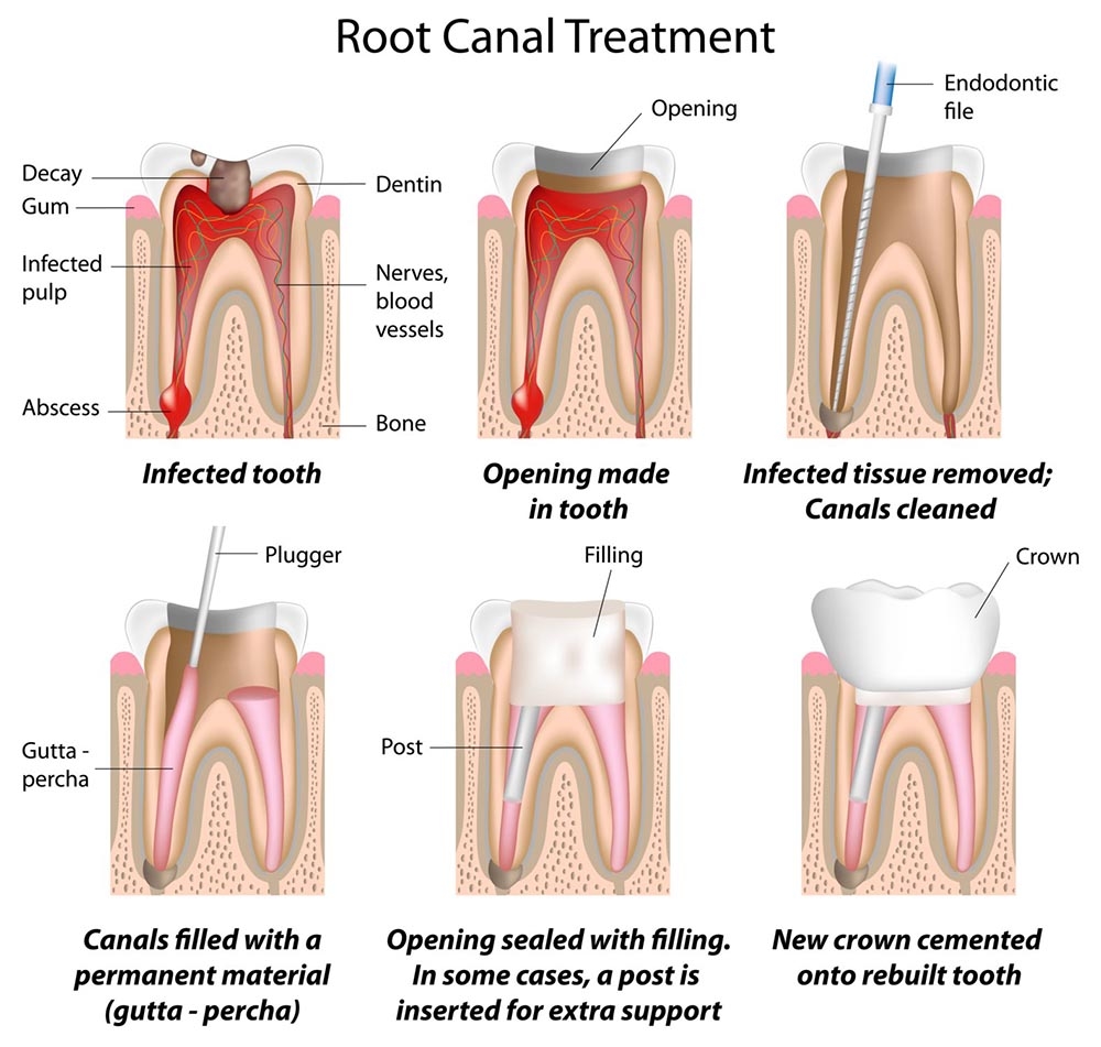 Diagram of Root Canal Procedure, Newton MA