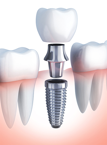 Dental Implants Near Newton MA